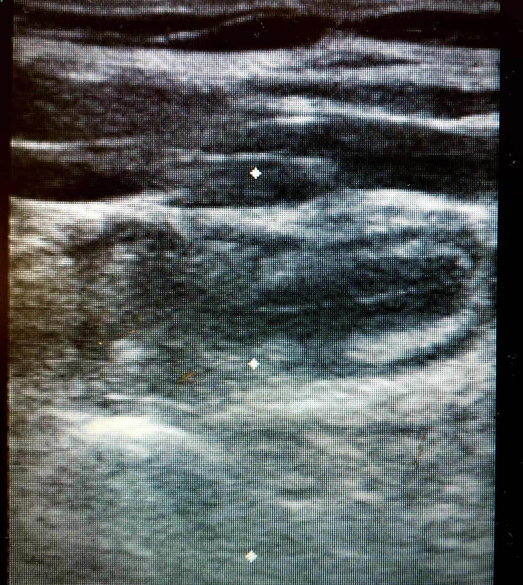 pesosEM's tweet photo. 15 y/o m w/ periumbilical abd pain, mild RLQ pain. #POCUS showed noncompressible tubular structure, target sign, 1.1 cm diameter. #Goodolduktrasound for the win ⁦@DoctorsEMres⁩ https://t.co/gp6KQTeAbr