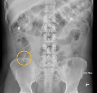 New Publication! What do you see on this plain abdominal XR? 

Find out what it is and what happens here: sciencedirect.com/science/articl…

#Medtwitter #foreignbody 🪒💩 #embound #FOAMed <a href="/ELS_Emerg_Med/">Emergency Medicine</a> @matthewdeIuca @EuropSocEM <a href="/afemafrica/">The African Federation for Emergency Medicine</a> <a href="/SEMI_India/">Society for Emergency Medicine India</a> <a href="/IFEM2/">ifem2</a>