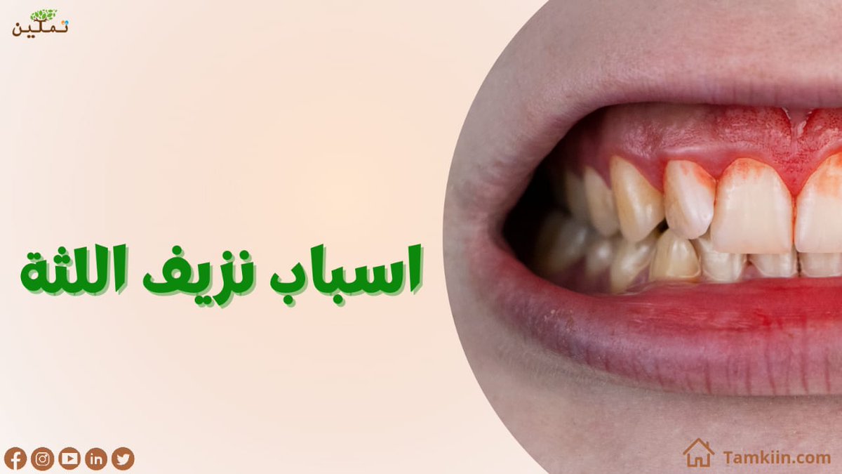 Tamkiin4's tweet photo. أسباب نزيف اللثة😩
✅نقص #الفيتامينات مثل #فيتامين #سي
✅التغيرات الهرمونية 
✅الإصابة ببعض #الأمراض مثل #السكري 
✅#التدخين
✅تناول مضادات التجلط
✅ #الهيموفيليا
✅#الاستخدام الخاطئ لفرشاة وخيط الأسنان. https://t.co/94RpZPoP7h