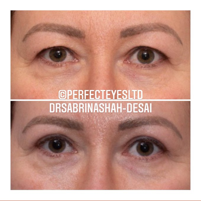 jullia_smith's tweet photo. My heavy hoods bother me, what'll an upper lid blepharoplasty achieve without a brow lift #upperlidblepharoplasty can be effective in clearing hoods&amp;giving a natural result,without additional brow liftsurgery
https://t.co/kUwrHflTrj
📱+447480022435
ophthalmology@meetingsnexpo.com https://t.co/HOvdzyNw80