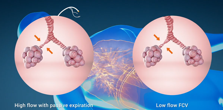How does FCV® improve aeration and gas exchange? Watch this animation!

ventinovamedical.com/concept/