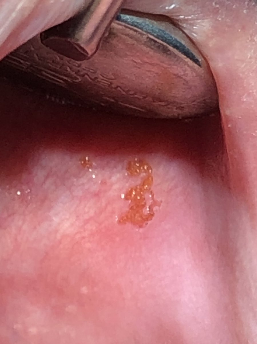 كطبيب أسنان عام لا تعالج المشكلة اللي عند المريض وتمشيه وخلاص، لازم تاخذلك لفة على باقي الاسنان وتفحص اللثة واللسان والخد عالسريع وتسأله عن وضعه الصحي، لأنه احيانا بتكتشف اشياء المريض اصلا ماهو داري عنها وهنا يكون دورك بتحويل الحالة للأخصائي مع ملاحظاتك..خدمة كبيرة للمريض ونفسك👌