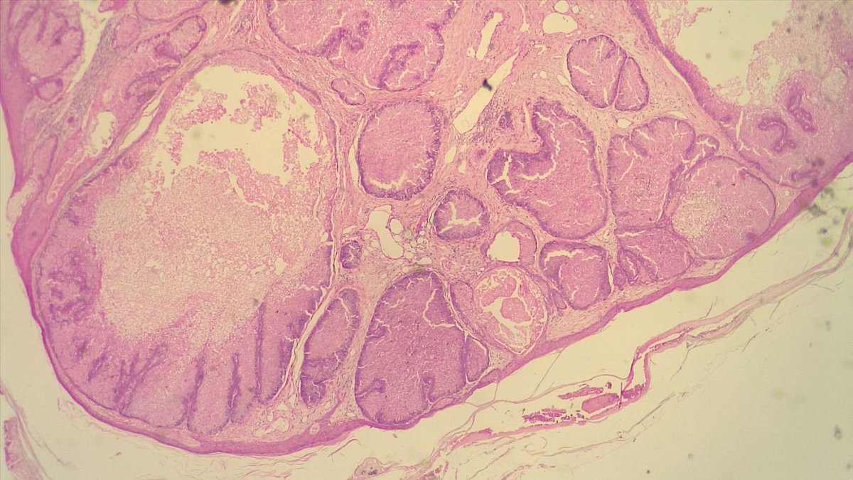 BuddingLiska's tweet photo. What would you call this skin adnexal tumour if it had >50% basaloid cells along the periphery? Thank you @LiezanneM 🌟 https://t.co/lmsHkqvlRD
