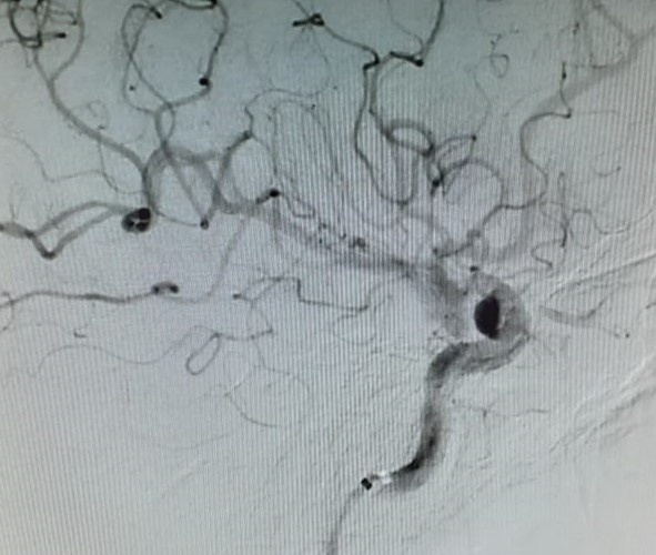 phenox_neuro's tweet photo. Another interesting case shared by #BioSud about an #aneurysm treated with the #p64 #FlowModulation Device (4.0x21mm) at Sanatorio Aconcagua in Córdoba, Argentina. Thanks to Dr Sebastián Juliá, Dr Facundo Saravia, Lic Mansilla Pablo, Robassio Eloy, Lopez Clelia & Silvina Gogenola https://t.co/Ih0DhBxIY4