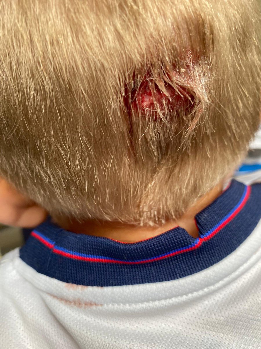 AndrewTadman's tweet image. Lad bust his head open today at nursery goes hospital to have it glued, doctor asks is he watching footie tonight, yep he says so doc says who’s ur favourite player, does he say Kane, Sterling, nope says @yates_jerry 😂😂, unofficial member of this team mate #ENG #Blackpoolfc