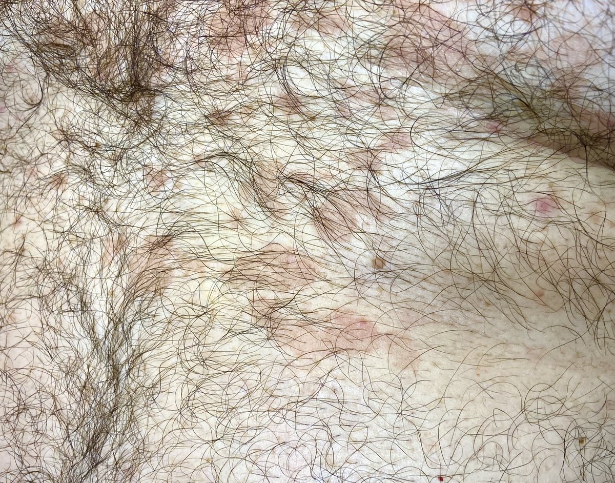 AndamoyoAlberto's tweet photo. Un motivo frecuente de consulta, máculas discrómicas que se hacen más evidentes con la exposición solar, hablamos de la entidad denominada pitiriasis versicolor #malasezzia #discromia #dermatologia #ConsultaPopular https://t.co/V8PYf34CeY