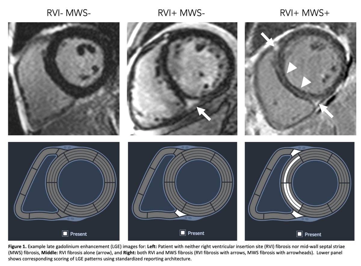 JAWhiteMD's tweet photo. Is RV Insertion Site Fibrosis relevant in patients with DCM? Objective reporting criteria presented with associations to bi-ventricular remodelling and clinical outcomes from the CIROC Registry. See full JCMR paper: https://t.co/6wPfNObaod https://t.co/6g6EQmuJ5l