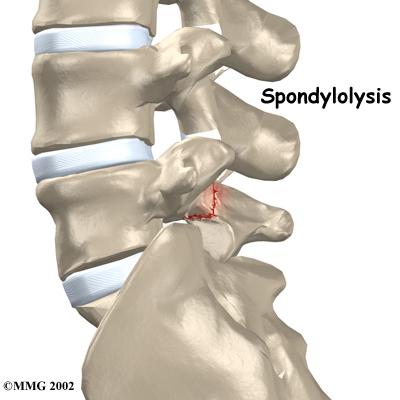 Hard to pronounce, easy to understand: Lumbar Spondylolysis
Learn more about the condition on FYZICAL Algonac's website.
fyzical.com/algonac/Injuri…
#lowbackpain #lumbarspondylosis #symptoms #cause  #fyzicalalgonac #physicaltherapy #yoga  #livepainfree #treatmentoptions #loveyourlife