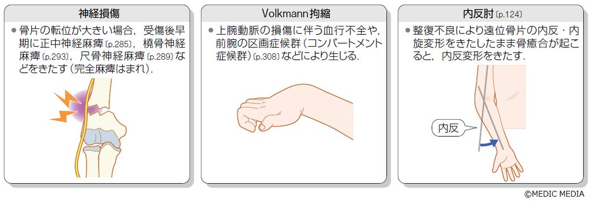 骨折合併症 白熱講義 骨折合併症 Nonunion, Malunion, FRI, PTOA−骨折治療
