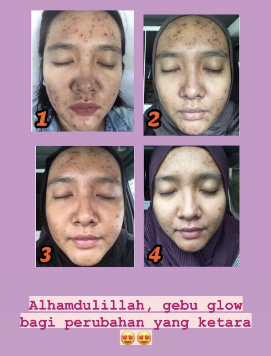 awesomejdk1's tweet photo. GEBU GLOW solusi masalah KULIT anda 😍!! Ayuh dapatkan GG anda sekarang.. https://t.co/nZtiQicJRF