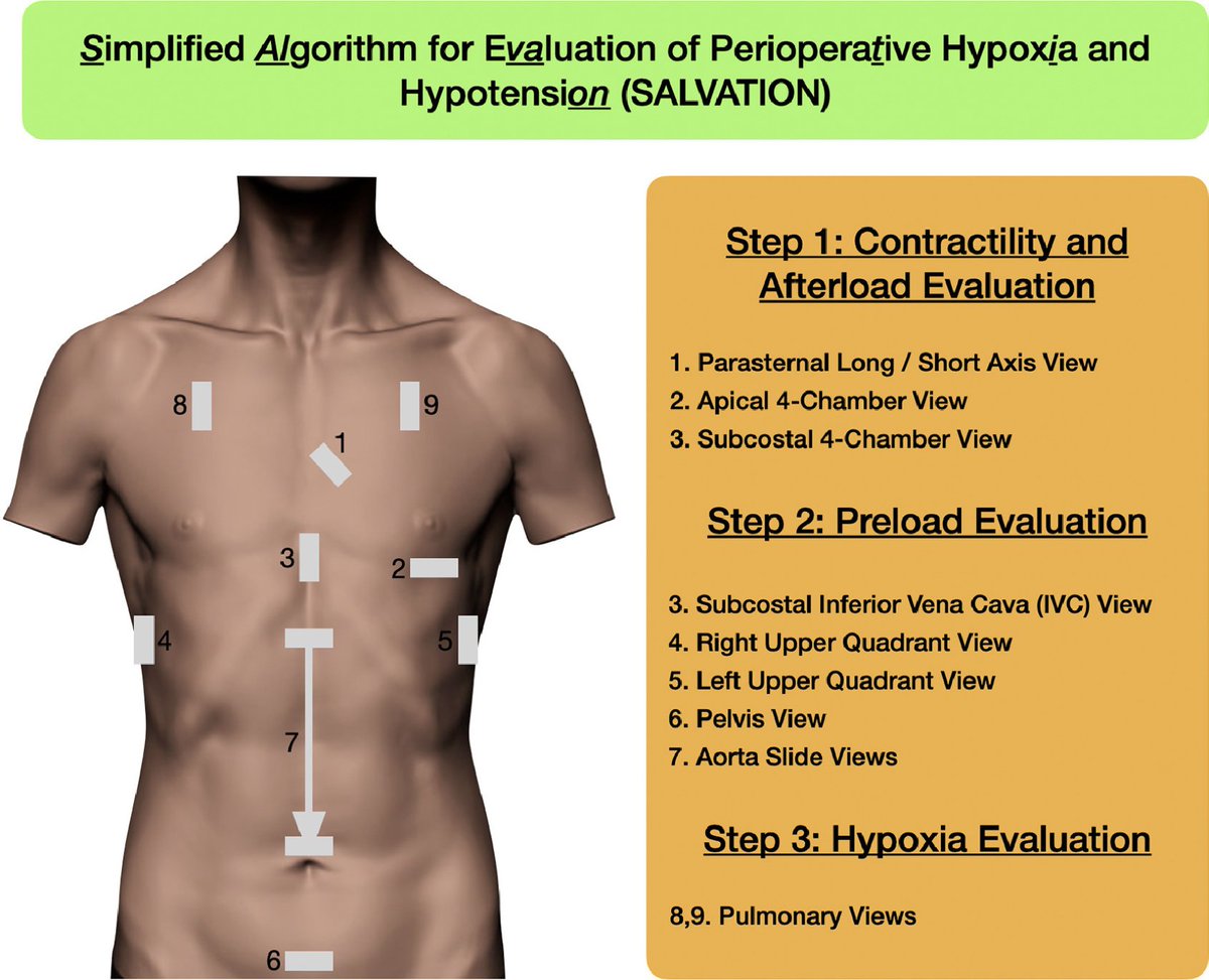 A simple, sequential and focused multiorgan approach, applicable for the evaluation of perioperative hypotension and hypoxia in emergency scenarios. #pocus #echofirst jcvaonline.com/article/S1053-…