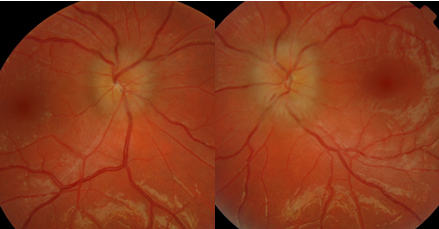 Case of the week <a href="/CHRU_Tours/">CHRU de Tours</a> @FacmedTours <a href="/twit_anjo/">Association Nationale des Jeunes Ophtalmologistes</a> | 20 year-old woman, acute bilateral vision loss to 20/200 (Monoyer 1/10) and headaches. Normal blood pressure, no intracranial mass on brain imaging, normal CSF pressure and composition. What else could it be?