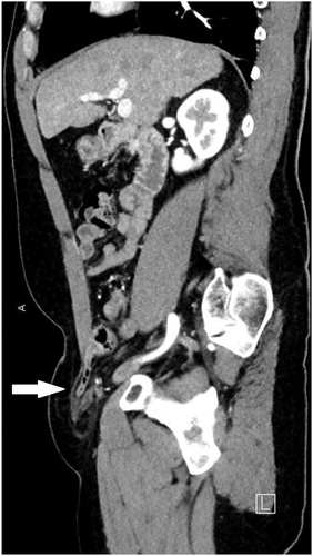 New in JACEP Open: Male with right lower quadrant pain.
#FOAM, #ImagesInEM
buff.ly/3qQqLJu
<a href="/EmergencyDocs/">Emergency Physicians</a>, @ACEPNow, <a href="/WileyHealth/">Wiley Clinical and Health</a>, <a href="/WileyinResearch/">Wiley in research</a>