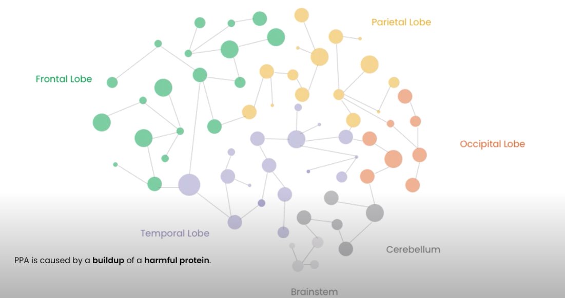 #PrimaryProgressiveAphasia is a dementia syndrome that affects language. We’re still learning how #PPA affects the brain and how harmful protein affect different areas of the brain. This video highlights what we know so far ⬇️
youtu.be/8lbJyCAtva8