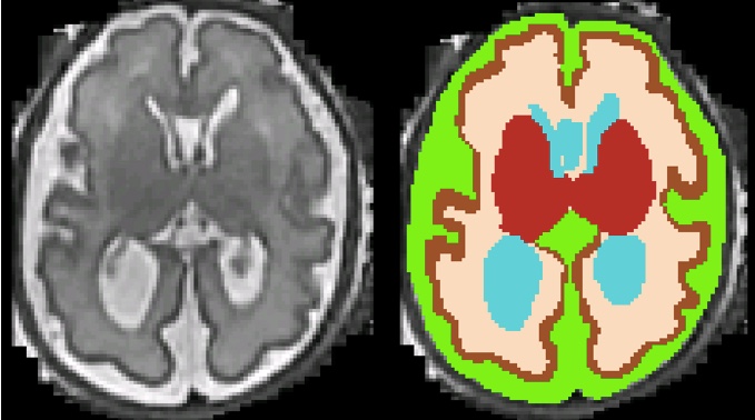 Tiny Human Brains (@andrasjakabmd) on Twitter photo Bringing #OpenScience and #MachineLearning to fetal #MRI Proud to present our paper on the Fetal Tissue Annotation Dataset <a href="/ScientificData/">Scientific Data</a> <a href="/Nature/">nature</a>
nature.com/articles/s4159… <a href="/HamzaKebiri/">Hamza Kebiri</a> <a href="/i_ezho/">Ivan Ezhov</a> <a href="/jocpae/">Johannes C. Paetzold</a> @Suprosanna93 <a href="/MeriBach/">Meritxell Bach Cuadra</a> <a href="/KispiZuerich/">Kinderspital Zürich</a> <a href="/UZH_ch/">Universität Zürich</a> Thanks for sharing Bringing #OpenScience and #MachineLearning to fetal #MRI Proud to present our paper on the Fetal Tissue Annotation Dataset <a href="/ScientificData/">Scientific Data</a> <a href="/Nature/">nature</a>
nature.com/articles/s4159… <a href="/HamzaKebiri/">Hamza Kebiri</a> <a href="/i_ezho/">Ivan Ezhov</a> <a href="/jocpae/">Johannes C. Paetzold</a> @Suprosanna93 <a href="/MeriBach/">Meritxell Bach Cuadra</a> <a href="/KispiZuerich/">Kinderspital Zürich</a> <a href="/UZH_ch/">Universität Zürich</a> Thanks for sharing