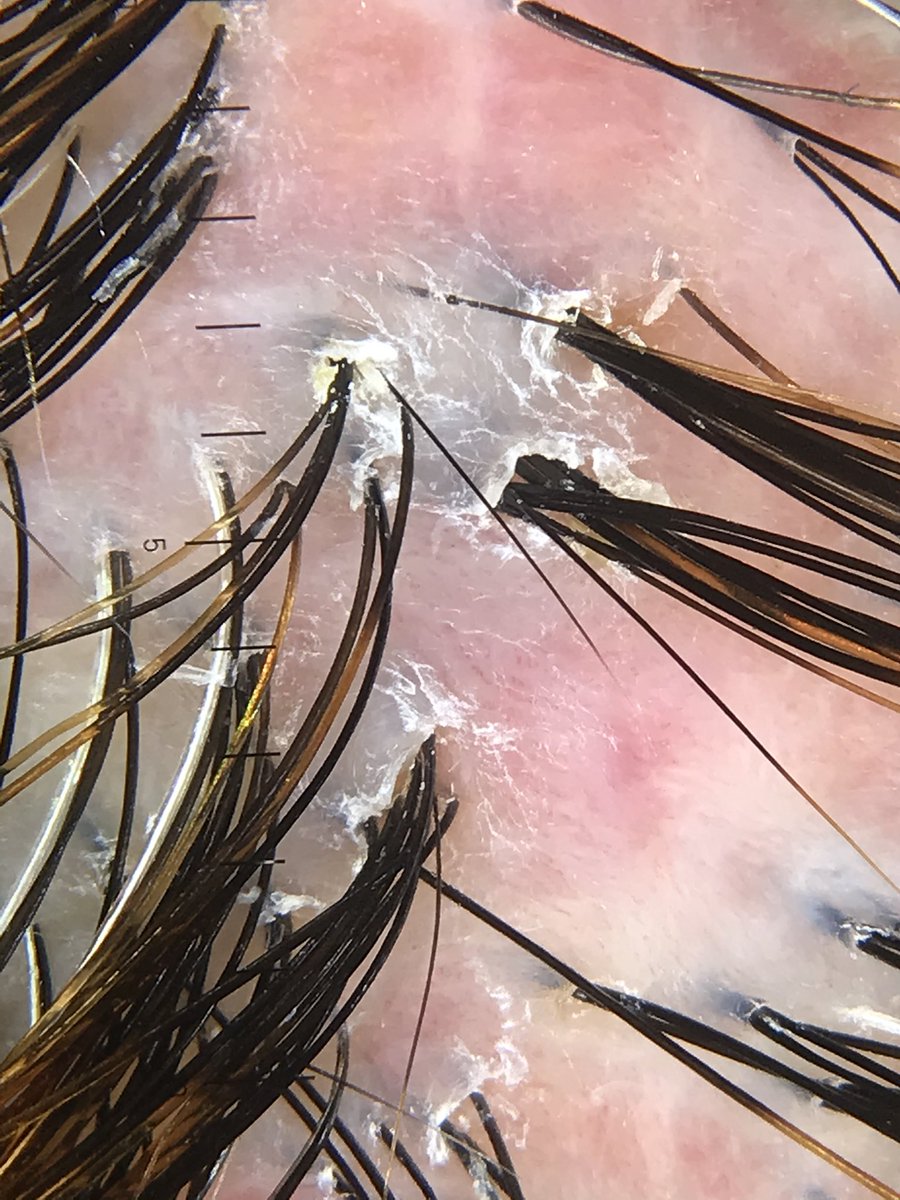 Last article from #TricoHRC Investigative Group - Topical dapsone for folliculitis decalvans: a retrospective cohort study, coordinated by dr. Ana L. Melián 🔝👏🏼 jaad.org/article/S0190-…