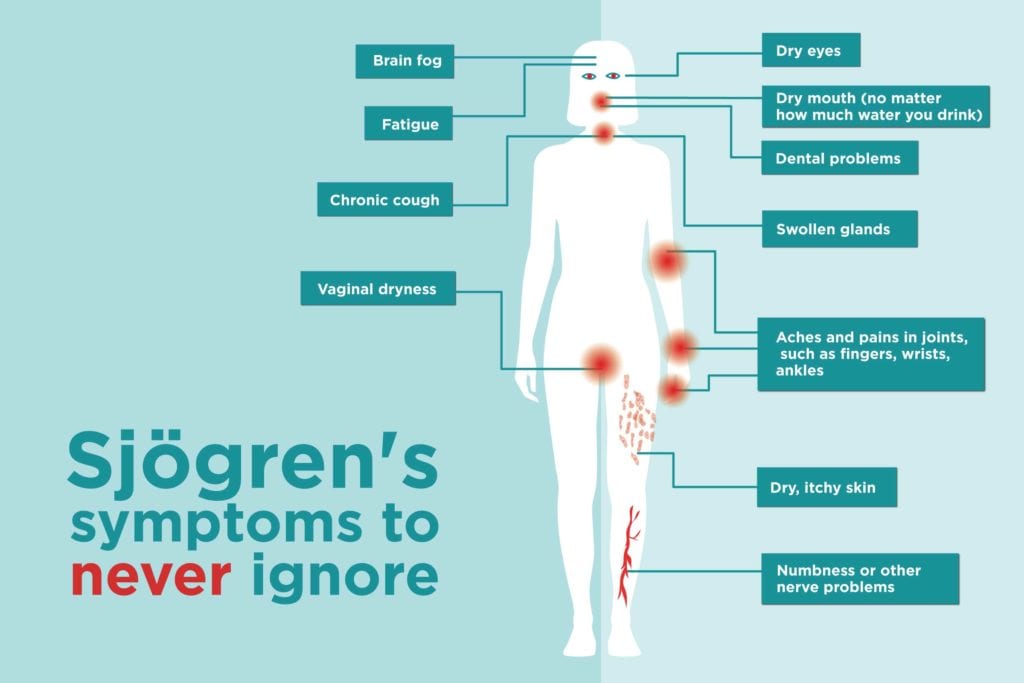 Síndrome de sjögren tratamiento natural Síndrome de sjögren tratamiento natural