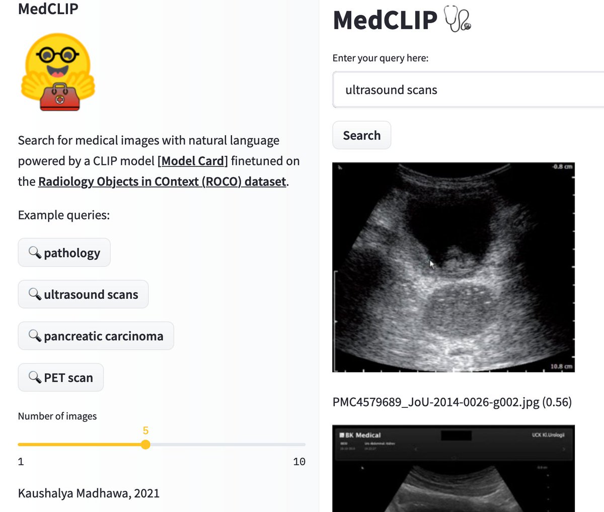 kau_mad's tweet photo. Thanks to the JAX/Flax community week, I had a chance to fine-tune a CLIP model on a radiology dataset (ROCO) on cloud TPU-v3-8. It was a quite fun learning experience.
☞Github repo: https://t.co/fms0foBdRE
☞@streamlit demo on @huggingface 🤗 Spaces: https://t.co/nlk7AuQmBo https://t.co/nszps04h65