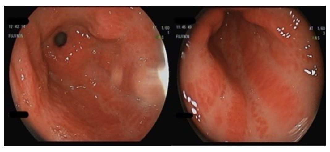 It's #WorldSjogrensDay and we're back with another clinical vignette poll (Sjögren's syndrome-related, of course). 

Case, question and poll in the thread 👇