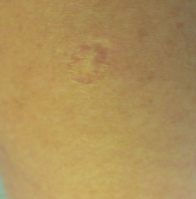 fedemagveg's tweet photo. Questo è  il "segno" che come molti della mia età hanno sulla spalla. È il vaccino contro il vaiolo. Se voi nati dopo non lo avete lo dovete pure a noi,perciò vaccinatevi contro il covid,vaccinatevi e molti altri in futuro vi ringrazieranno.
#COVID19 #vaccinoCovid https://t.co/YBxhhgYdsl