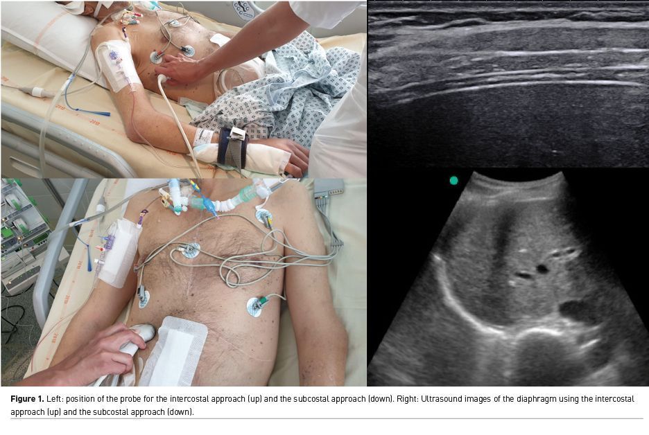 ICU_Management's tweet photo. 🛑 Yassir Aarab, Prof. @JABERSamir3 &amp; @audreydejongMD provide an overview of the principles and current applications of diaphragm ultrasound and innovative ultrasound-based techniques.
READ FULL ARTICLE HERE 👉https://t.co/dq8h1MgIFE
#ICU #Ultrasonography #Diaphragmdysfunction https://t.co/jG4ztQ4N97