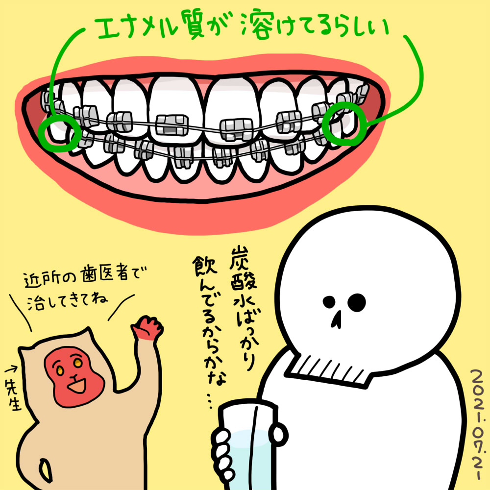 2021年7月21日(水) 1ヶ月ぶりの矯正歯科 下の歯にもブラケットとワイヤーを着ける予定だったけど、 初期虫歯が見つかったので手前1/3だけ着けて残りは治療後ということに……