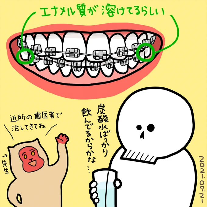 2021年7月21日(水) 1ヶ月ぶりの矯正歯科 下の歯にもブラケットとワイヤーを着ける予定だったけど、 初期虫歯が見つかったので手前1/3だけ着けて残りは治療後ということに……