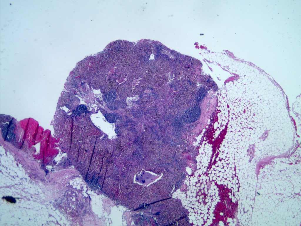 smlungpathguy's tweet photo. How did you get in there little fella? 

#ebustwitter #cytopath #pathology #pulmpath #laraslesion https://t.co/uc4Kkjyo3b