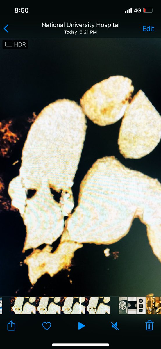Ditongaje's tweet photo. 3 years post S3 implant with increase MG to 48mmHg referred for TAVI in TAVI consideration. CT showed HALT. Treated with warfarin for 1 year and MG down to 20mmHg @weiqin_lin #tavi #tavr #structuralheartintervention #structuralheart #nuhcs #cardiologist https://t.co/vcaoyd6mB1