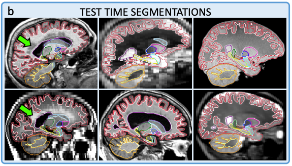 Juan Eugenio Iglesias (@juaneugenioigl1) on Twitter photo Preprint, code & model of SynthSeg are out! Obtain 1 mm segmentations of brain MRI scans of ANY contrast/resolution with a single CNN. Work with @LeemputKoen, <a href="/AdrianDalca/">Adrian Dalca</a>, @BruceFischl et al
<a href="/FreeSurferMRI/">FreeSurfer</a>
Try it now!
Code: github.com/BBillot/SynthS…
Paper: arxiv.org/abs/2107.09559 Preprint, code & model of SynthSeg are out! Obtain 1 mm segmentations of brain MRI scans of ANY contrast/resolution with a single CNN. Work with @LeemputKoen, <a href="/AdrianDalca/">Adrian Dalca</a>, @BruceFischl et al
<a href="/FreeSurferMRI/">FreeSurfer</a>
Try it now!
Code: github.com/BBillot/SynthS…
Paper: arxiv.org/abs/2107.09559