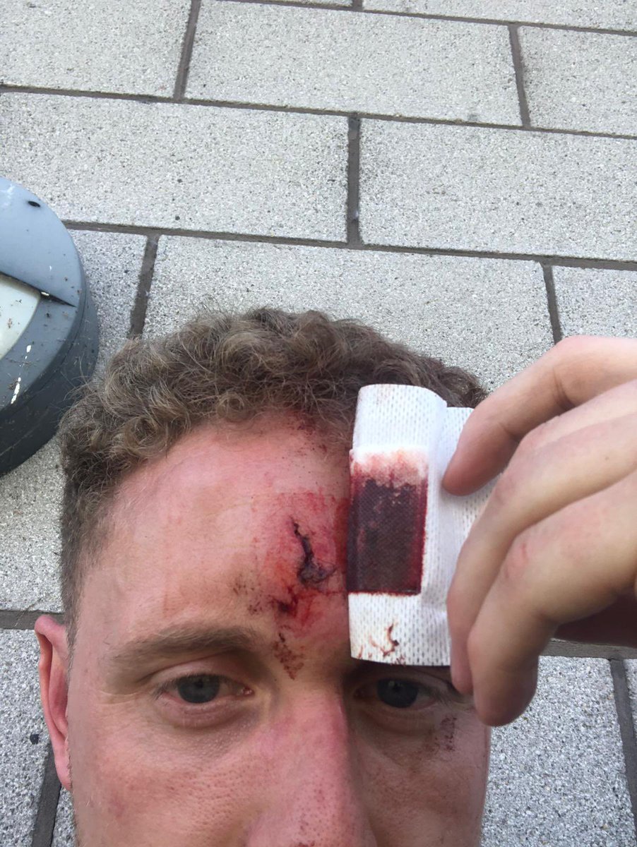 Update on lads 

Both lads are still off work but recovering. 

We call this john the 🐐 but he is currently known as the 🐼 

Thanks once again to <a href="/IFAWorldNET/">IFA WorldNET</a> <a href="/stjohnambulance/">St John Ambulance England</a> &amp; <a href="/musfc/">MUFC Supporters FC</a>