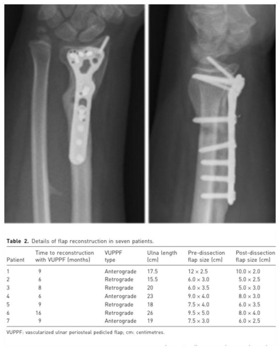Nuevo ARTÍCULO sobre el colgajo perióstico vascularizado ulnar en una serie pediátrica
▪️Opción muy útil en pseudoartrosis de antebrazo
▪️Publicado en “Journal of Hand Surgery (European Volume)”
▪️Si os interesa el artículo escribir a enfermeria.icatma@gmail.com y os lo enviamos!