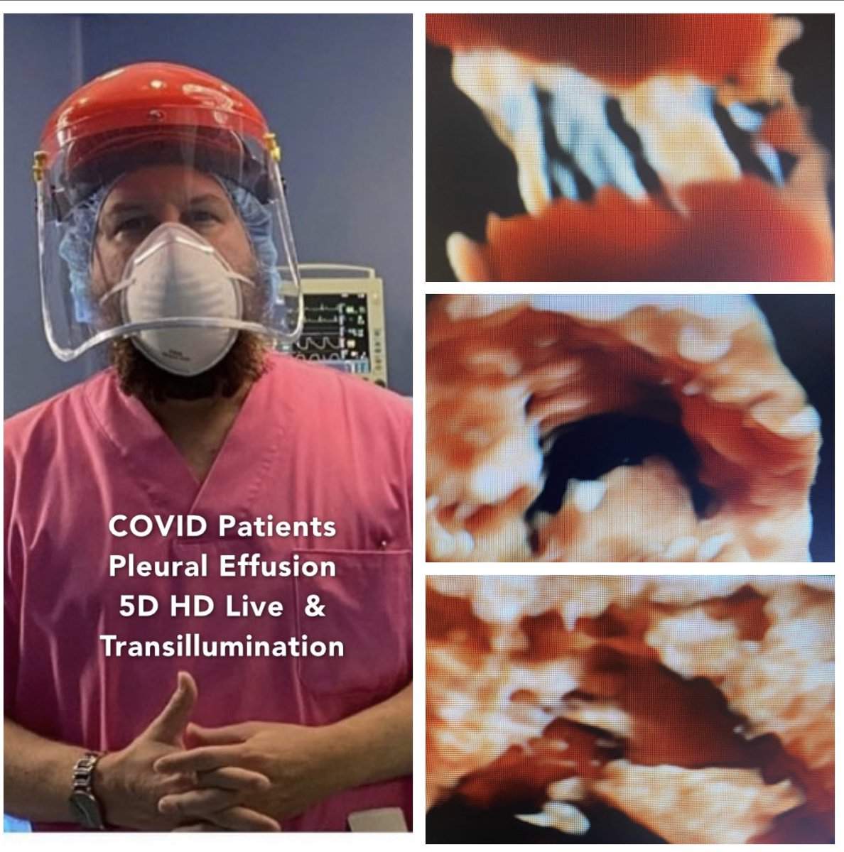 COVID Patients / 
Advanced Ultrasound HD Live + Transillumination 
My PrometheUS Project 
PLEURAL EFFUSION - ADRS 
#pocus #criticalcare #madrid #spain #Covid_19