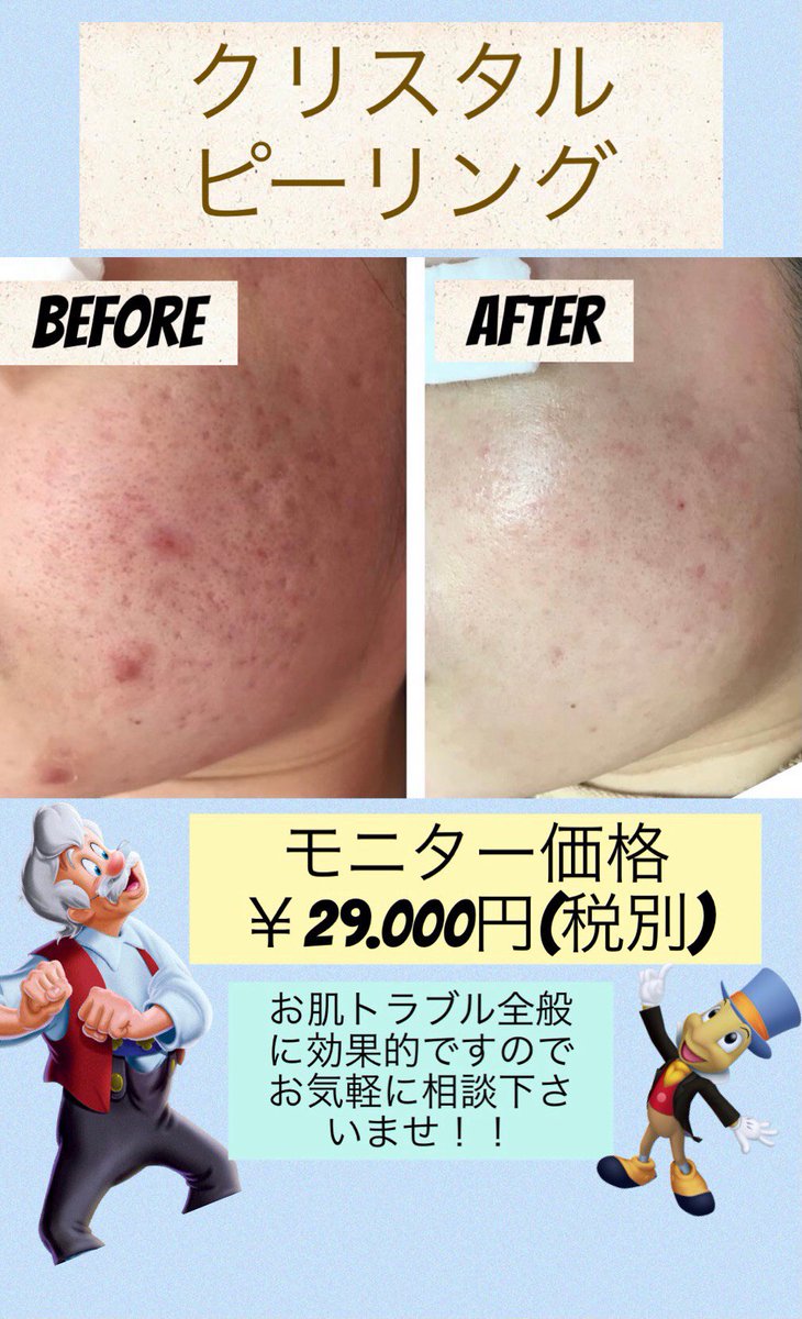 ハイドラフェイシャル Twitter Search