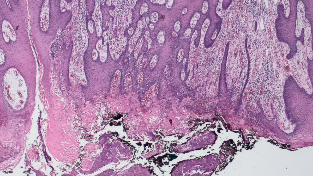 AnatPathLouis's tweet photo. /1 Top of the mornin' to you. Middle-aged man with suspected perianal squamous cell carcinoma...
Look at what I found!
#PathTwitter #dermpath #GIpath @JMGardnerMD https://t.co/C3j6En8bn3