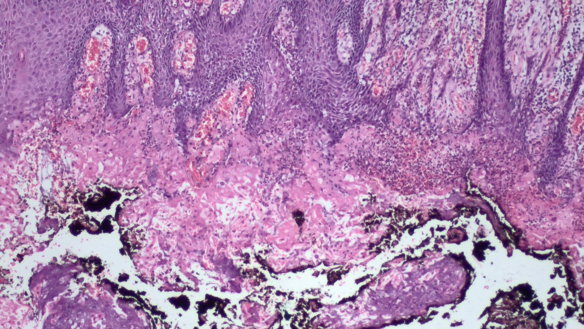 AnatPathLouis's tweet photo. /1 Top of the mornin' to you. Middle-aged man with suspected perianal squamous cell carcinoma...
Look at what I found!
#PathTwitter #dermpath #GIpath @JMGardnerMD https://t.co/C3j6En8bn3