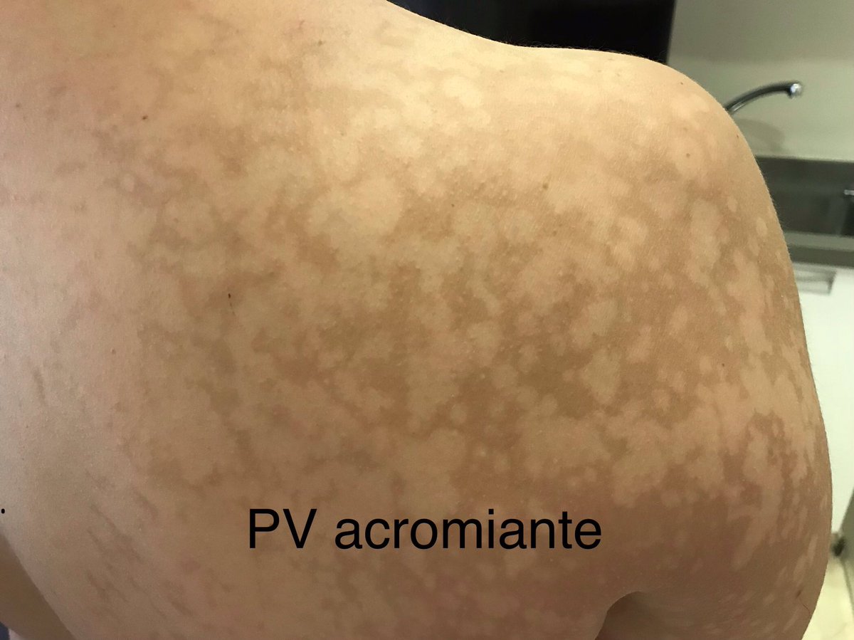julianconejomir's tweet photo. Pitiriasis versicolor. Es la misma enfermedad en invierno (eritematosa) que en verano (acromiante). La causa: por el 🌞 la levadura M.furfur produce un acido de decarboxilico (azelaico) y quedan manchas blancas durante meses. 
@DermaHUVRocio https://t.co/fiiZHxLppq