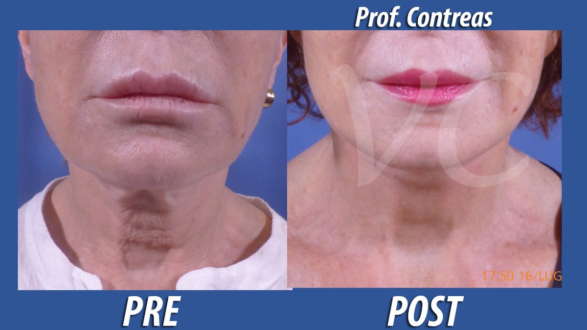 VitoContreas's tweet image. Lifting Ambulatoriale in Anestesia Locale

#PrePost #ProfContreas #ChirurgiaPlasticaRisultatiNaturali