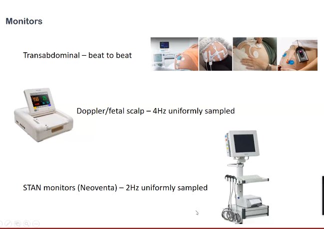 tsppm2021's tweet photo. How can we use routinely collected cardiotocography (#CTG) data during labour for research? How do we ensure they want and use well new technologies?
LIVE from #TSPPM2021 with A. Georgieva @oxfordfetal from @Ox_wrh @UniofOxford https://t.co/ZBmafTjEPP