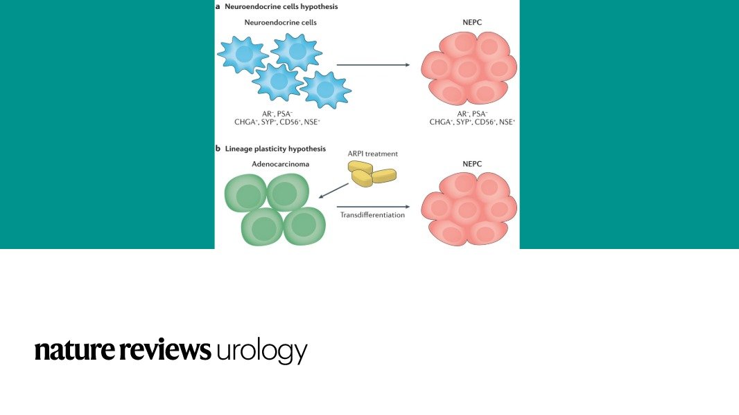NatRevUrol's tweet photo. #NEWinNRU in this Review Wang et al. describe molecular events in the development of neuroendocrine #ProstateCancer https://t.co/3iw1UzNkyB https://t.co/9Uf8tSGTIj