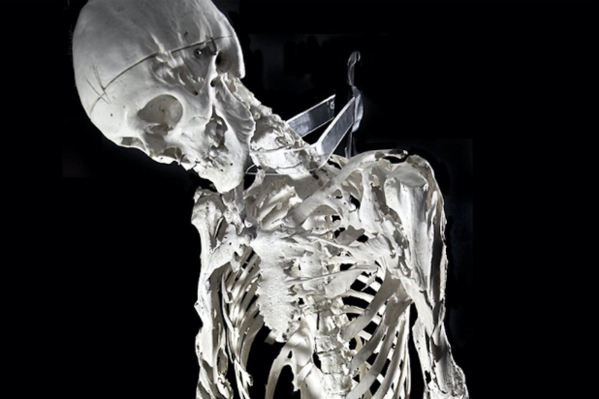 Оссифицирующая фибродисплазия. Синдром каменного человека. Оссифицирующая дисплазия. Эшли курпил. Эшли курпил.