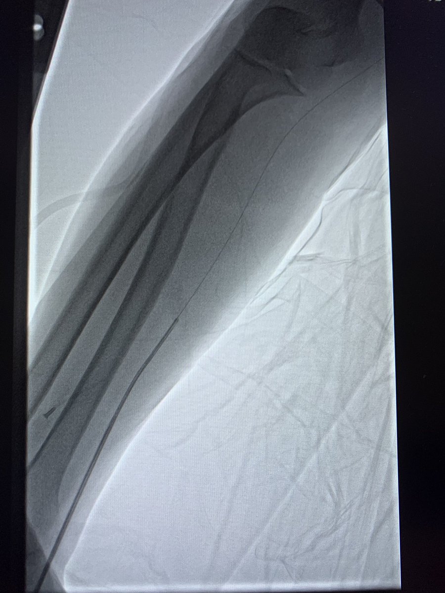 dimitri_zappi's tweet photo. Male75y, multiple previous CAG/PCI by regular Radial access.Came back again,no forearm radial pulse but some pulsatile in the snuffbox Would you try #RadialFirst again?Retrograde recanalization, The beauty of #dTRA access! @ferdikiem @w_jyg @kaschenke @KardiologieHH @HadyLichaaMD https://t.co/fTFyQpqUd7