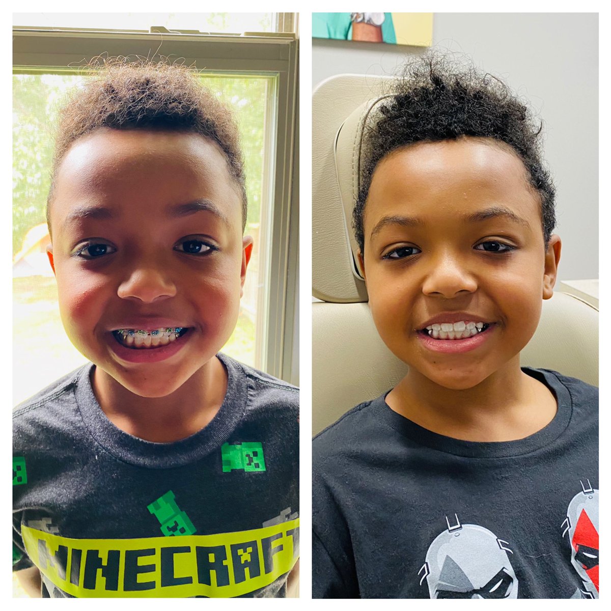 AJsAwesomeLife's tweet photo. How it started versus how it’s going!!! One day shy of having braces for a year, I got them off this morning!!! #HandsomeThen #HandsomeStill #BracesOff #AJsAwesomeLife #OrthoEdition https://t.co/HmIInhtyVj