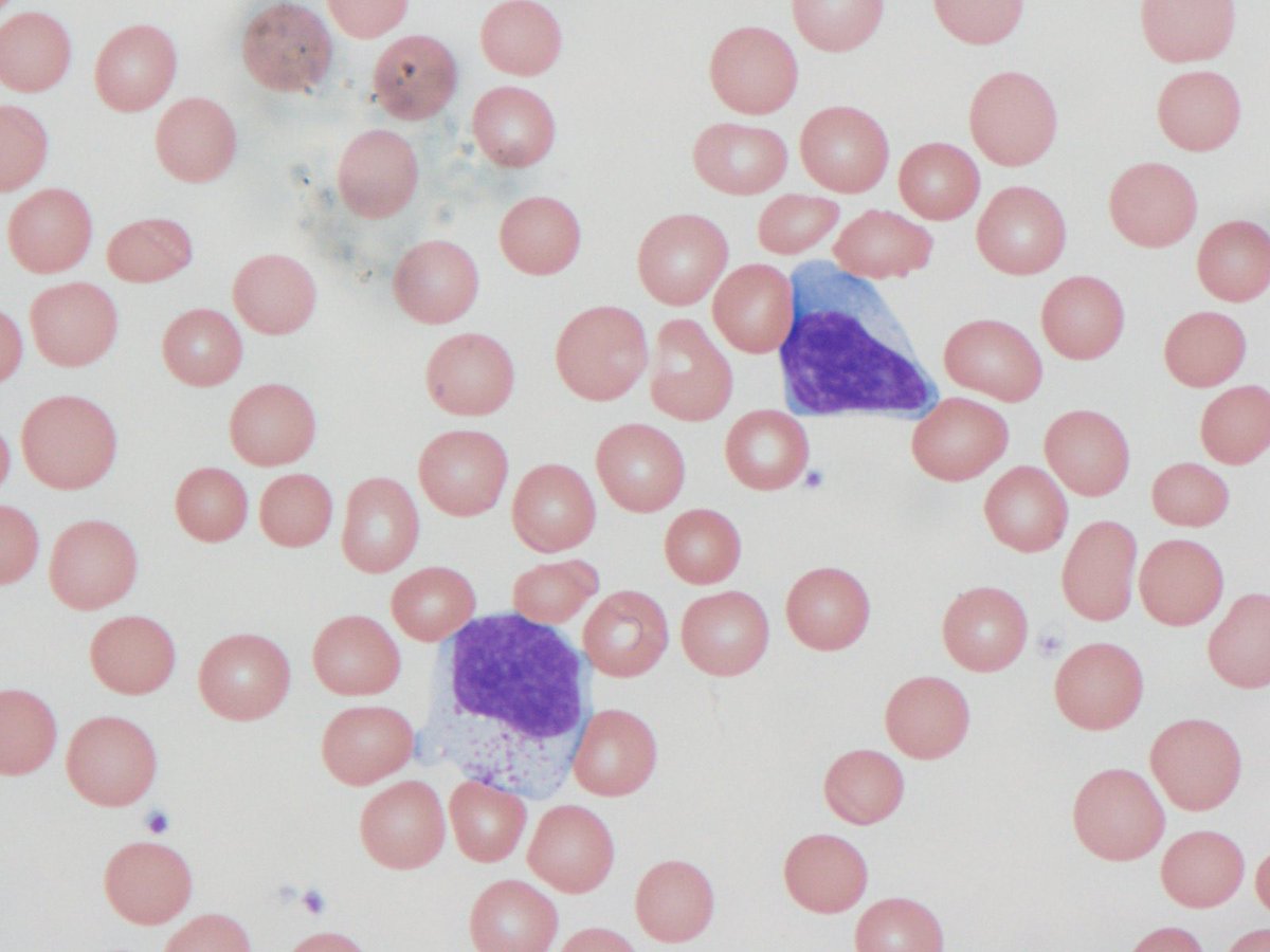 lbsmithmd's tweet photo. Child with fatigue and normal platelet count. What is your diagnosis?  #pitallsinheme #PathTwitter https://t.co/dVxRssxOI7
