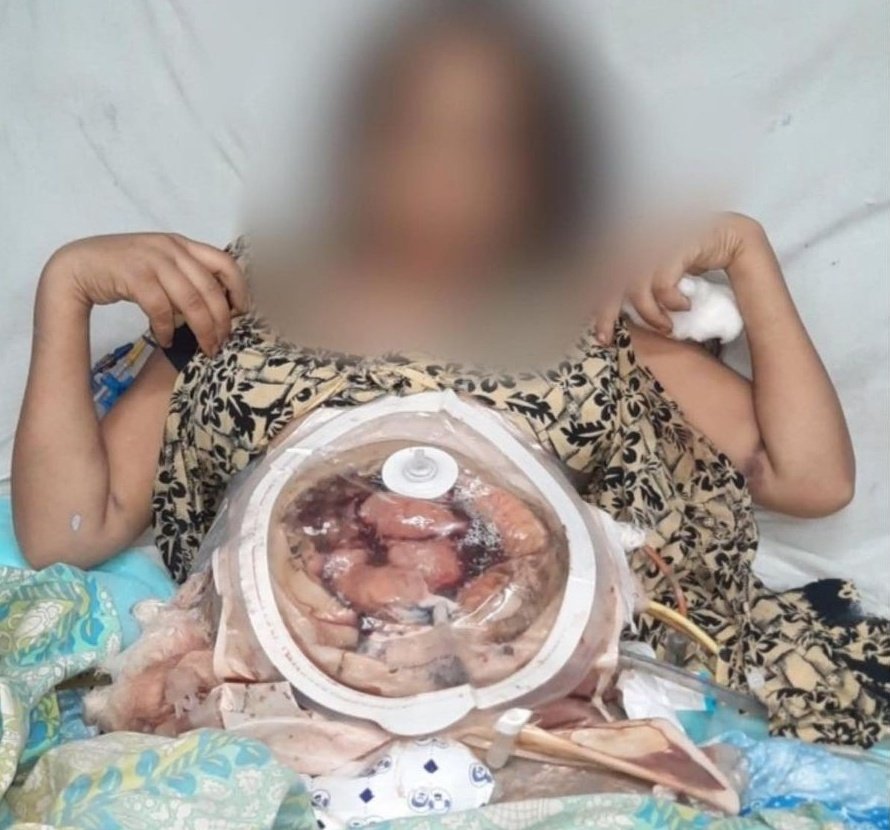 youthaginstrape's tweet photo. A 25-year-old girl from #Gwalior was forced to drink acid by her husband &amp; in-laws on June 28, she was admitted to the hospital in critical condition. An FIR for Domestic Violence has been registered on July 3 by Gwalior police, without adding the sections of Acid Attack. https://t.co/dp3UEK7OFr