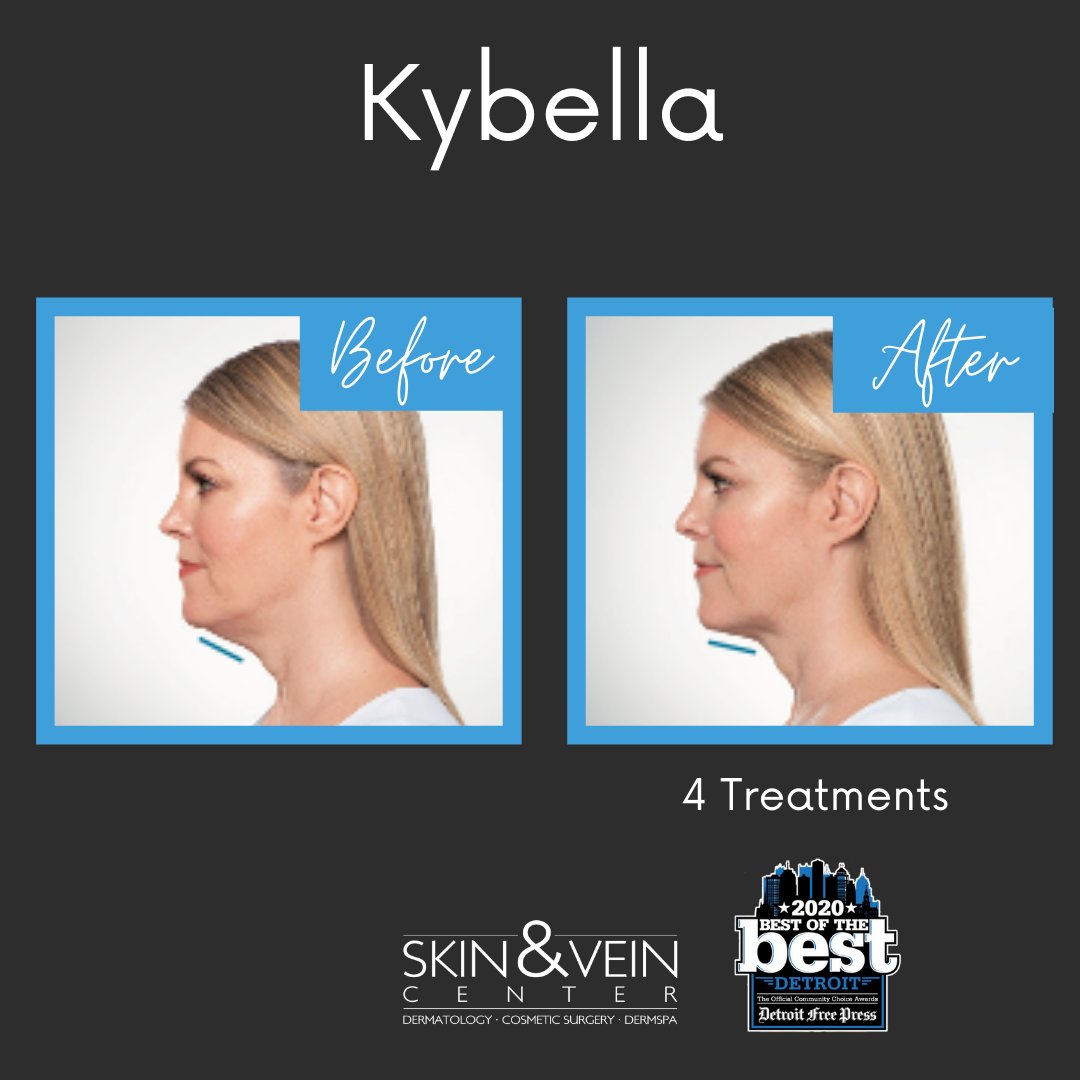Permanently melt away unwanted fat under the chin without surgery! Call today for your free, no-obligation Kybella consultation! 
#kybella #necklift #nonsurgicalnecklift #doublechin #kybellatreatment #doublechintreatment #skinandvein #skinandveincenter