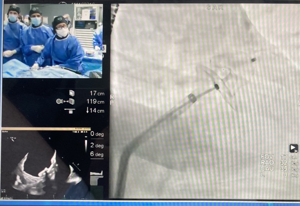 thomas_nest's tweet photo. Great Live Case at #TVT2021 from Vancouver @UBCmedicine Challenging LAAC using #Versacross from @BaylisMedical, Amulet device and the new steerable sheath from @AbbottNews, fusion imaging and #Feops pre-implantation measurements. @crfheart @docsaw @nzcardiologist https://t.co/aj71PhRIQC
