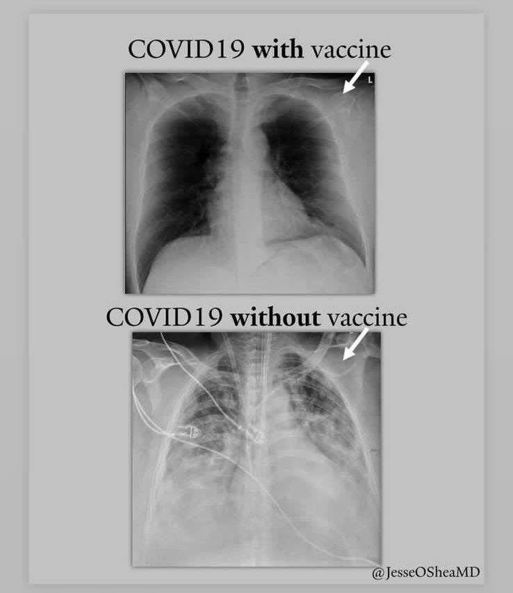 Maluavi's tweet photo. Para qué vacunarme, si de todas formas me puede dar #COVID19?  Aquí la respuesta. Gracias @JesseOSheaMD #teamvacunitas https://t.co/OlGA7VNGxO