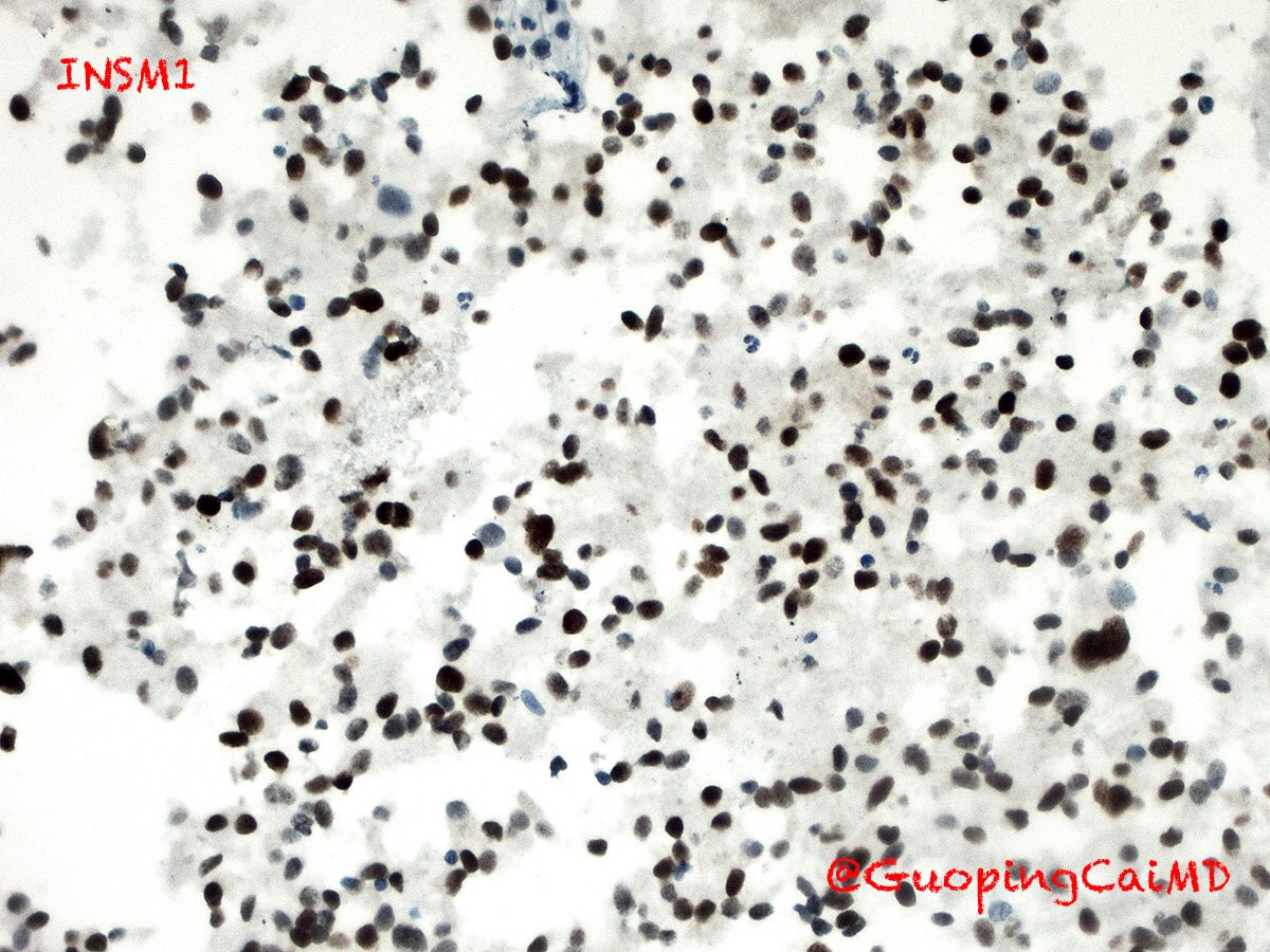 71/M with a 5.8-cm pancreatic body. Oncocytic neuroendocrine tumor of the pancreas. #cytopath #cytology #pancreas #FNA