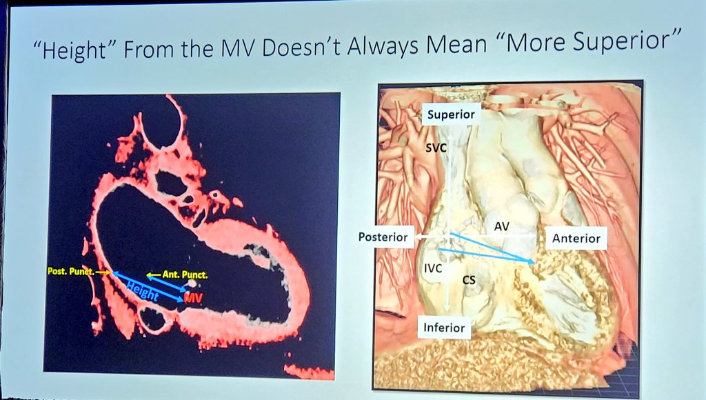 Adnan Alexander Kassier, MD. FACC. FSCAI (@akassier) on Twitter photo Excellent fellows corner session on trans-septal puncture #TS . 👀 #Sondergaard's groove. <a href="/crfheart/">Cardiovascular Research Foundation</a> #TVT2021 <a href="/mainlinehealth/">Main Line Health</a> <a href="/CleveClinicCath/">Cleveland Clinic Cath Lab</a> <a href="/tnazifMD/">Tamim Nazif</a> Excellent fellows corner session on trans-septal puncture #TS . 👀 #Sondergaard's groove. <a href="/crfheart/">Cardiovascular Research Foundation</a> #TVT2021 <a href="/mainlinehealth/">Main Line Health</a> <a href="/CleveClinicCath/">Cleveland Clinic Cath Lab</a> <a href="/tnazifMD/">Tamim Nazif</a>